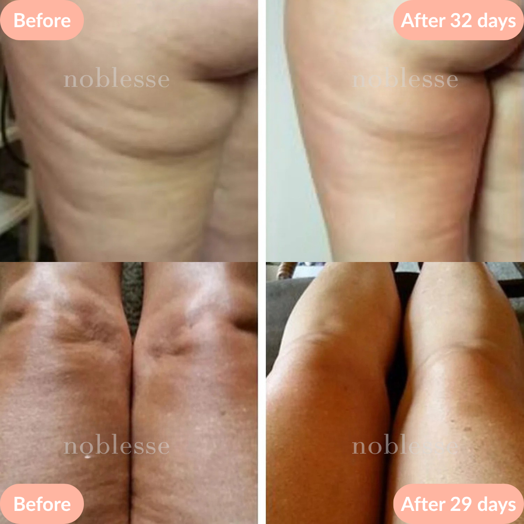 Anti-Cellulite Bundle - Stimulate Your Circulation
